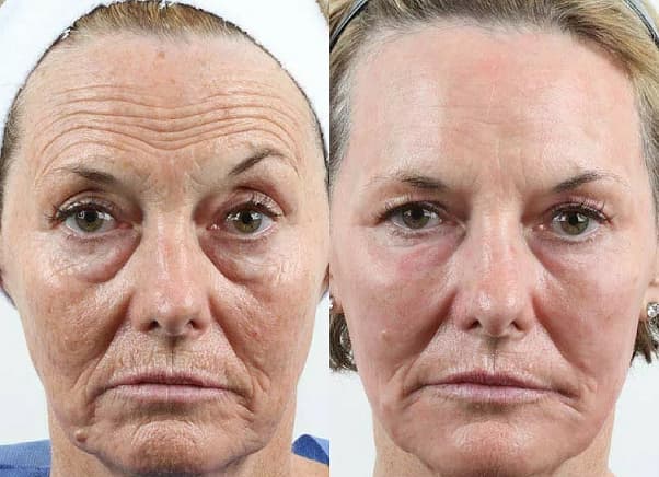 Skin Tightening