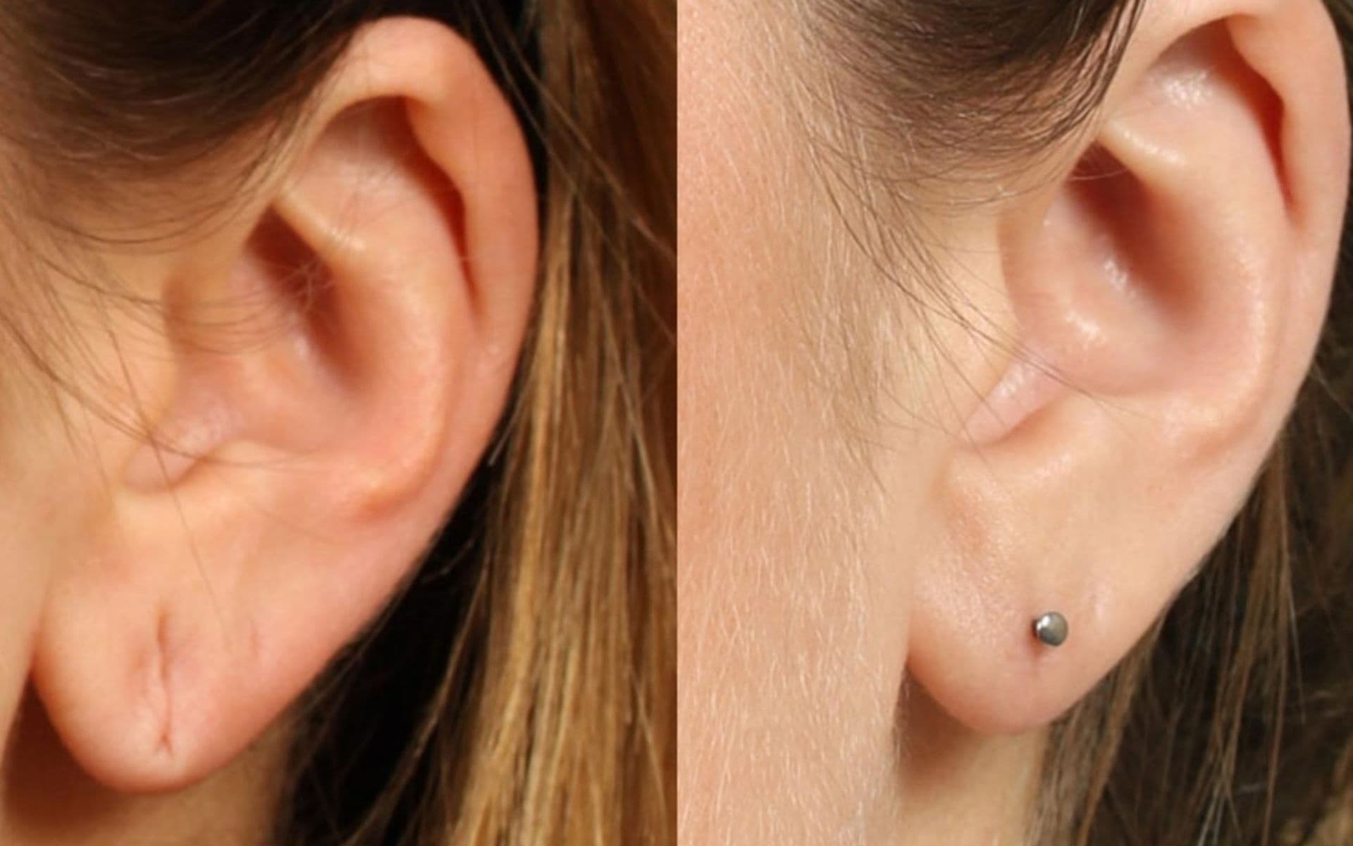 Ear Lobe Repair