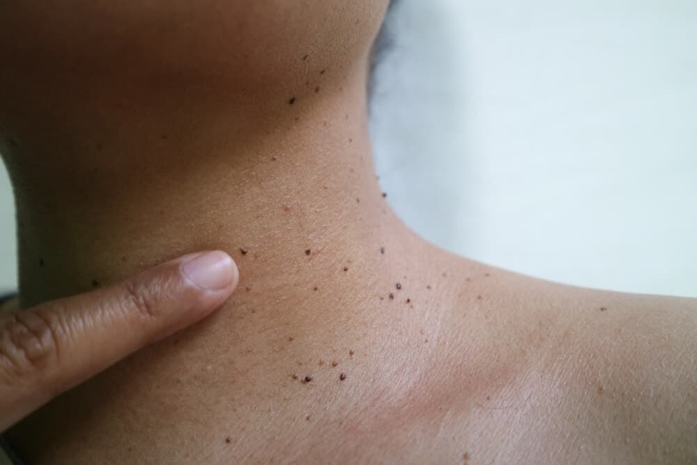Freckles, Warts & Skin Tags Removal