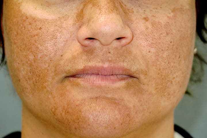 Hyper Pigmentation (Melasma)