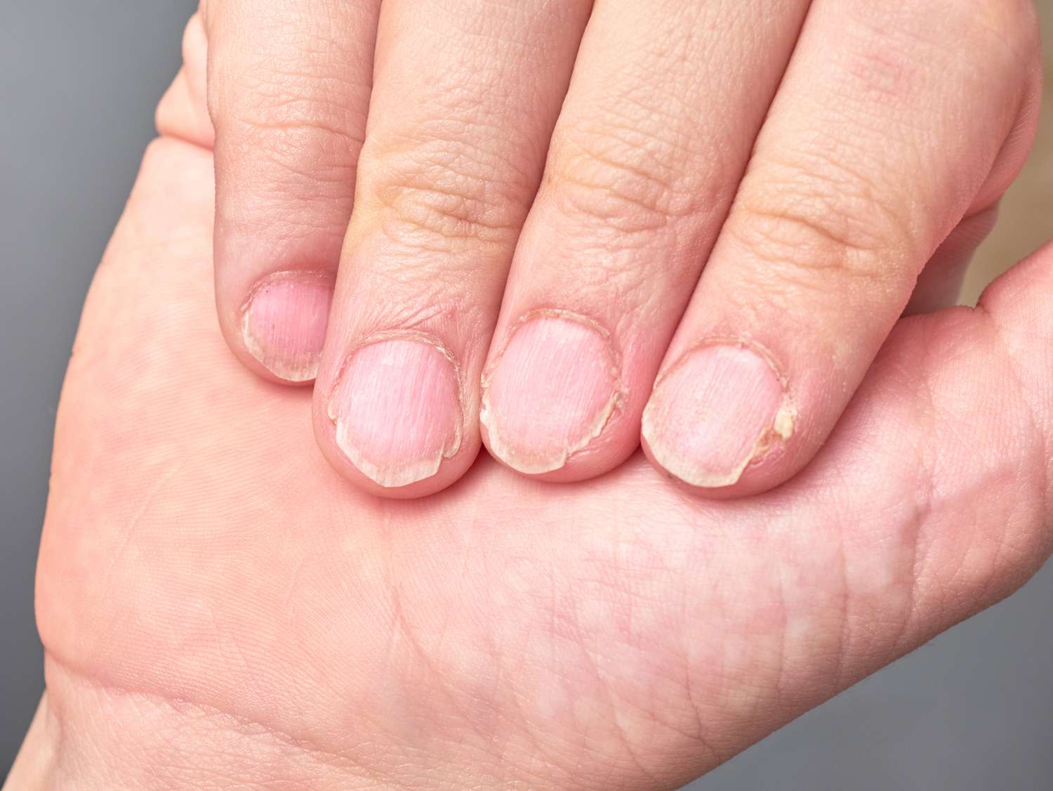 Nail Disease Treatment
